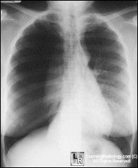 Tension pneumothorax